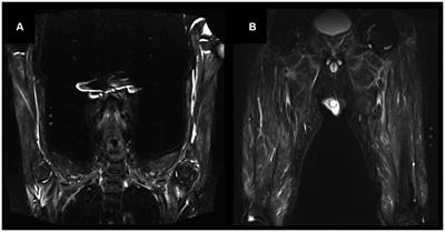 Antineutrophil cytoplasmic antibody-associated vasculitis with predominant truncal muscle weakness: a retrospective case series